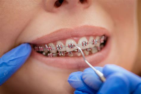 As we age, these misalignments will worsen if left untreated. Understanding Orthodontic Braces | Lancaster Orthodontist