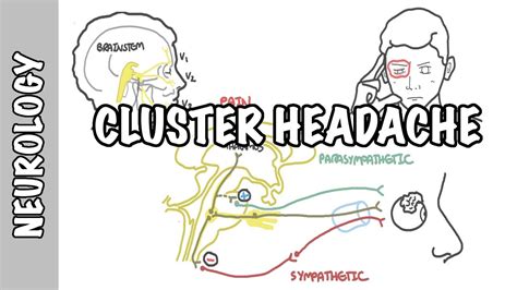 Cluster Headaches Symptoms Pathophysiology Treatment Youtube