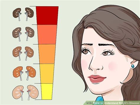 How To Understand Brights Disease 14 Steps With Pictures
