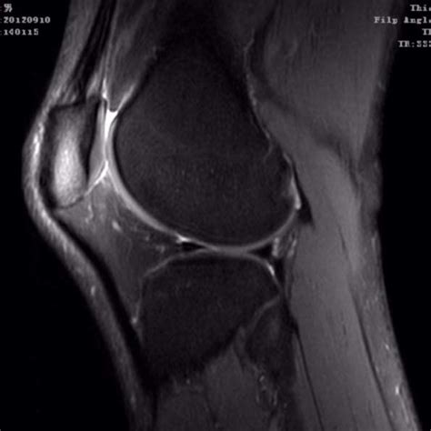 Coronal T2 Fs Mri Image Of Knee Joint Download Scientific Diagram