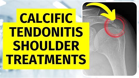 Calcific Tendonitis Shoulder Treatments Without Surgery YouTube