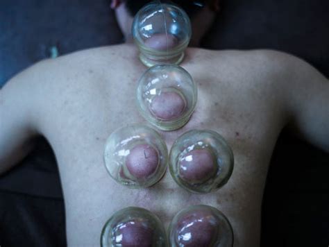 Theres No Evidence Cupping Works Why Is It So Popular