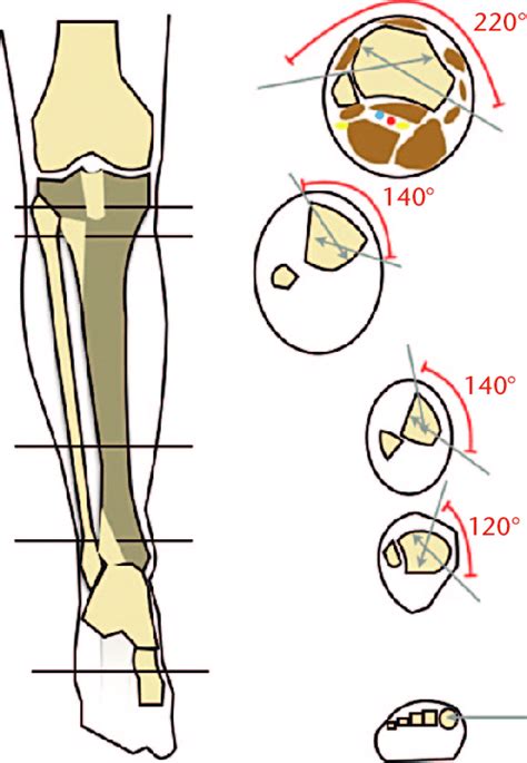 Safe Zones For Inserting Pins In The Region Of The Tibia At The