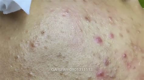 Golden Hematoma Big Mass In Thigh New Cysts Pops And Pimples Pimple