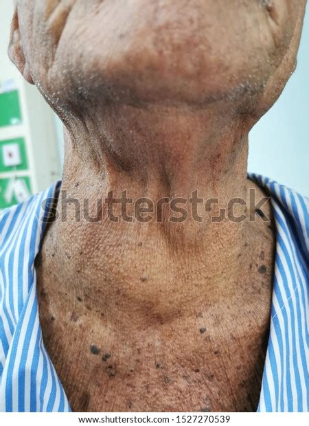 Anterior Neck Swelling Goitre Enlargement Thyroid Stock Photo