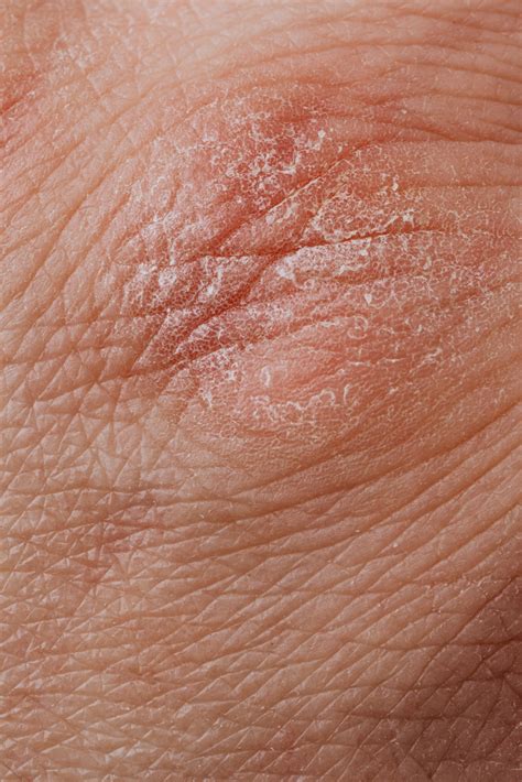 The Genetics Of Skin Inflammation Seen With Unprecedented Clarity