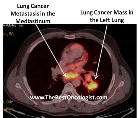 Treatment Of Lung Cancer The Best Oncologist Tm