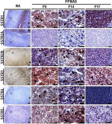 Although the majority of cases are diagnosed in the 2nd and 3rd decades of life, a substantial proportion of patients present. Immunohistochemical analysis of somatostatin receptors ...