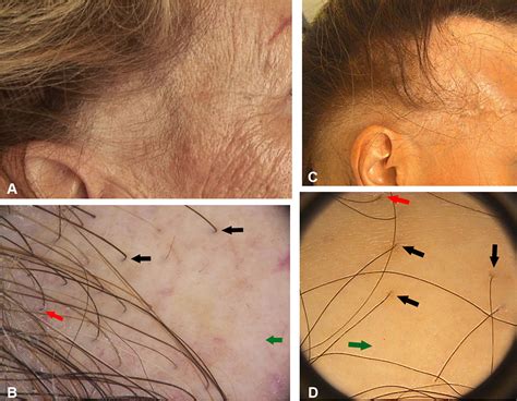 Unusual Patterns Of Presentation Of Frontal Fibrosing Alopecia A