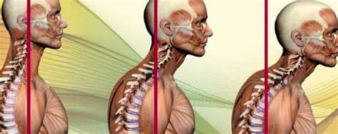 Forward Head Posture Dr Guy Ashburner Osteopath