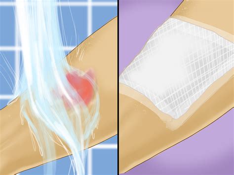 How To Treat A Chemical Burn Steps With Pictures