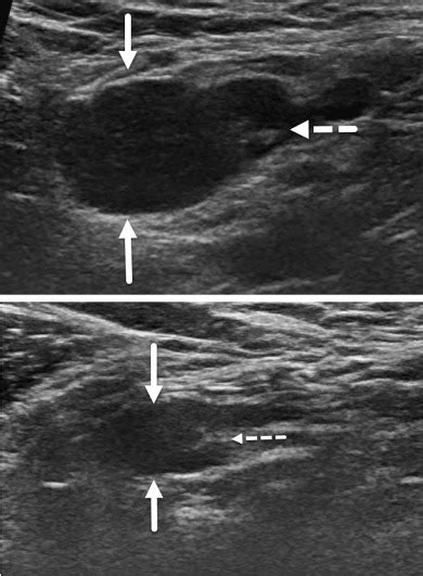 Ultrasound Features To Differentiate Covid 19 Vaccine Induced Benign