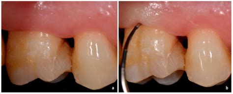 Dentistry Journal Free Full Text Furcation Involvement