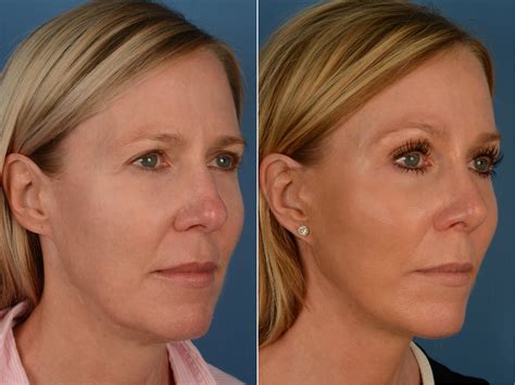 Rhinoplasty The Uplift Lower Face And Neck Lift Photos Naples Fl