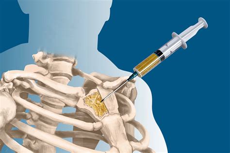 Is Biopsy Safe In Bone And Soft Tissue Cancers Some Myths And Facts