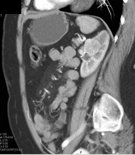 Incidental Papillary Renal Cell Carcinoma Left Kidney Kidney Case
