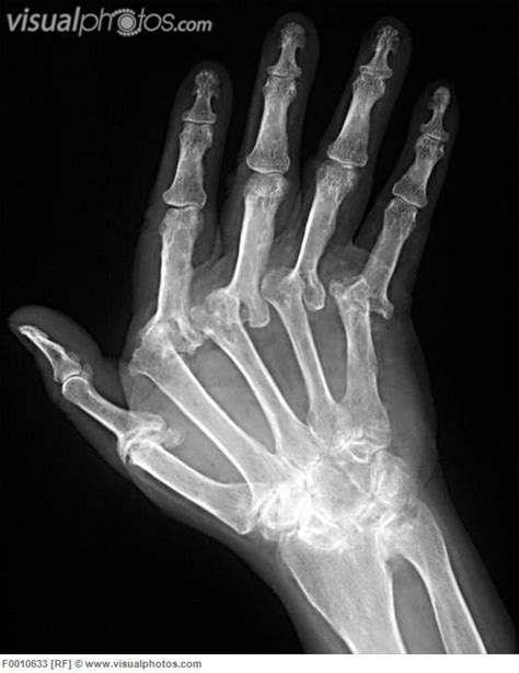 Subluxations and joint malalignment also occur. arthritis Xray images for website | hand. X-ray of the ...