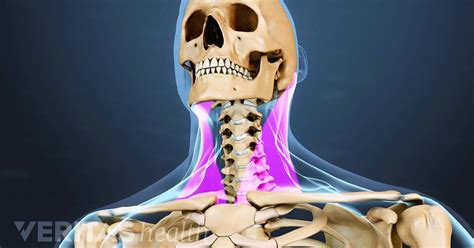 Neck Strain: Causes and Remedies