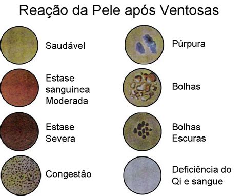 Ventosaterapia Significado Das Cores