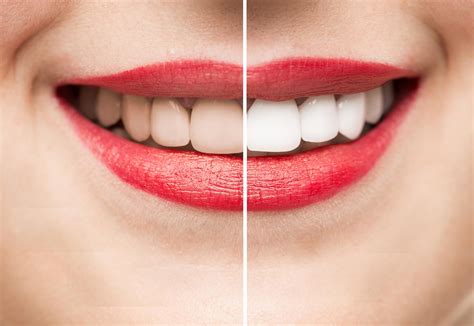 How To Get Whiter Teeth Four Top Tips To Help Achieve A Brighter Smile