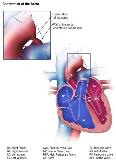 Congenital Heart Defects Facts About Coarctation Of The Aorta Cdc 2023