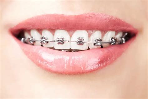 Reasons To Consider Braces As An Adult Orthodontist And Orthodontics