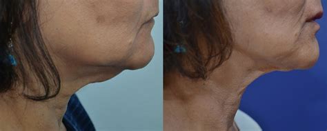 Patient 4588451 Fractora Skin Gallery Tansavatdi Facial Plastic Surgery