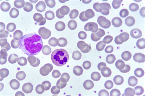Monocyte En Neutrophil Cel In Bloedvlek Stock Foto Afbeelding