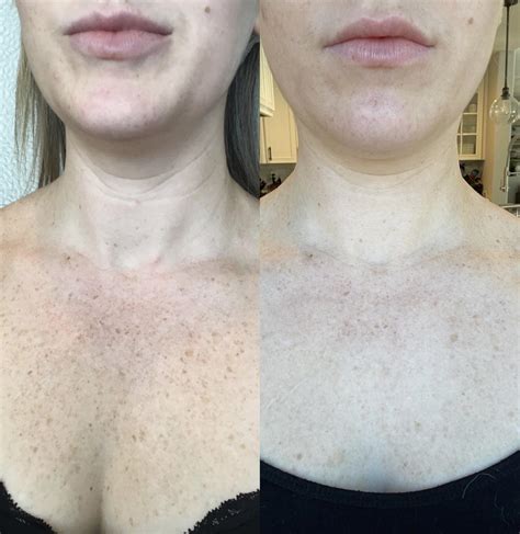 Ipl Before And After Photo Gallery Sacramento Ca Destination