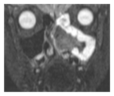 Fungal Sinusitis In 7 Year Old Male With Symptoms Of Nasal Obstruction