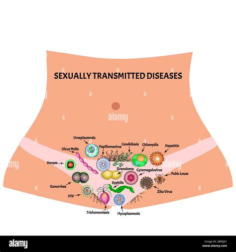 Viral And Bacterial Infections Sexually Transmitted Diseases Infographics Vector Illustration