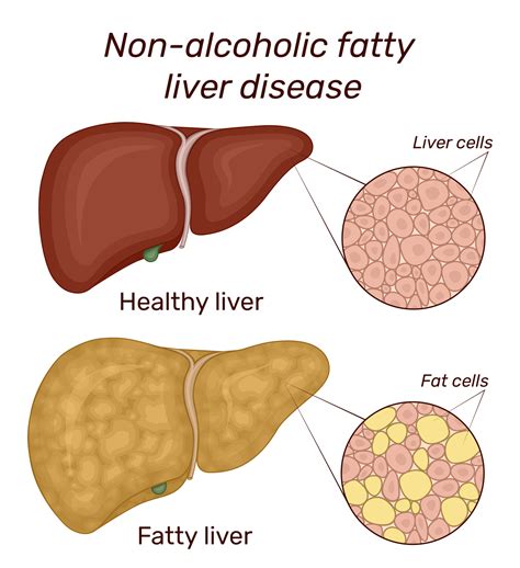 Non Alcoholic Fatty Liver Disease Know The Symptoms