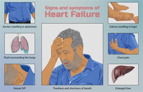 Congestive Heart Failure Physiopedia