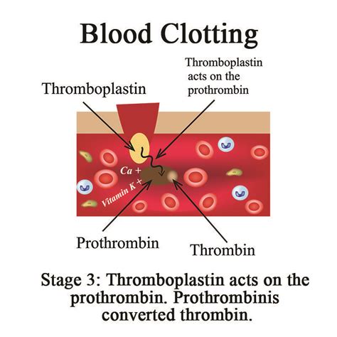 Thrombophlebitis The Vein Institute At Ssa