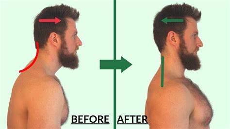 Fix Forward Head Posture 12 Minute Daily Corrective Exercise Routine