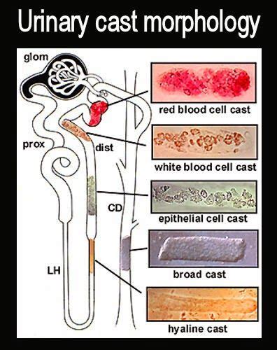 Medical Laboratory And Biomedical Science Urinary Cast Morphology