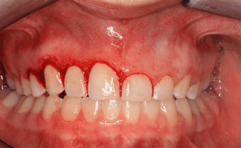 What Is The Difference Between Gingivectomy And Gingivoplasty News