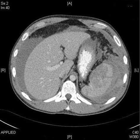 Transverse Section On Ct Abdomen Showing Free Fluid Blood And