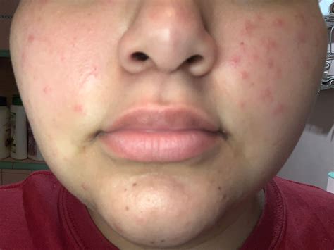 Red Spots On My Face Not Acne Beauty Insider Community