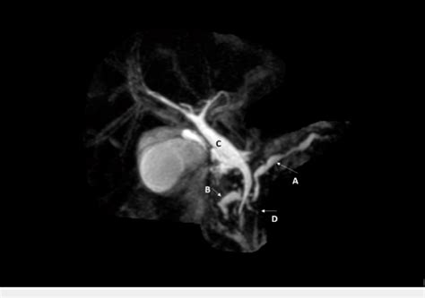 Magnetic Resonance Cholangiopancreatography Mrcp Of The Abdomen