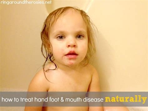 Naturally Treating Hand Foot And Mouth Disease Using Shaklee Basic H