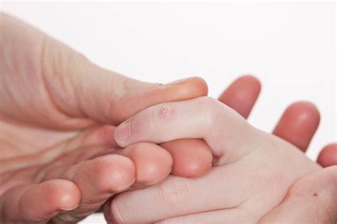 Treatment Options For Cutaneous Viral Warts In Children Dermatology