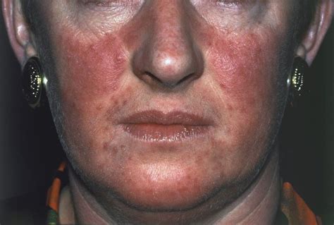 Topical Minocycline Foam Safe Effective For Papulopustular Rosacea