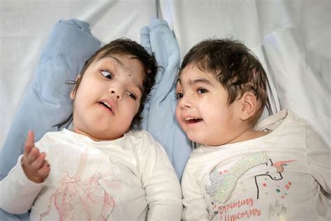 Twin Girls Conjoined At The Head Separated After 50 Hours Of Surgery