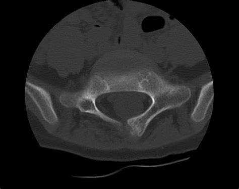 Aneurysmal Bone Cyst Sacrum Radiopaedia 65190 74195 Axial Bone