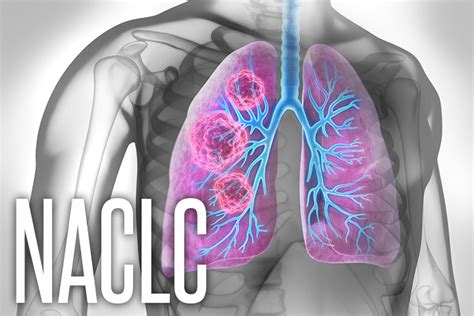 Radiomics Could Help Id Lung Cancer Prognosis After Screening Medpage