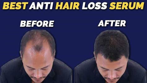 Best Anti Hair Loss Serum Review That Gives Rapid Hair Growth Youtube