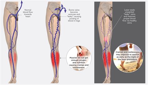 Restless Legs Leg Cramps Often Symptom Of Varicose Veins Alsara Vein Clinic