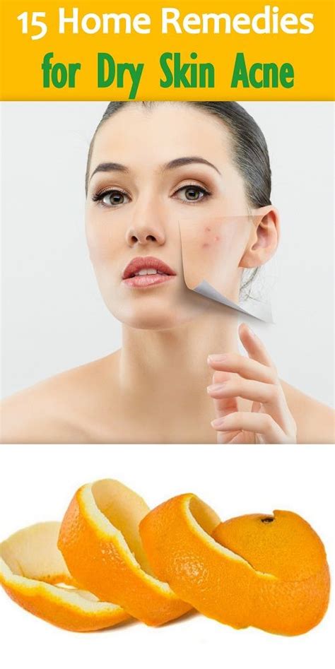 15effectivehomeremediesfordryskinacne How To Remove Pimples