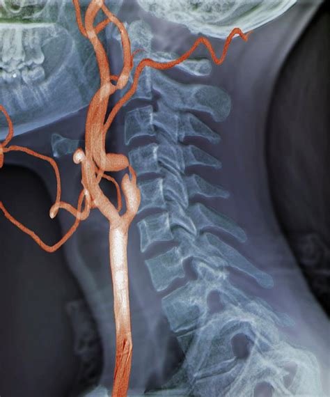 Stenosis Of Carotid Artery Photograph By Zephyr Science Photo Library